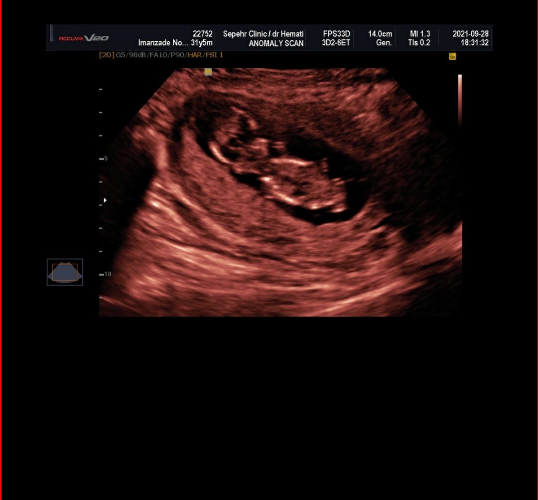 ریسک یا عدم ریسک در آزمایش ان تی ریسک یا عدم ریسک در آزمایش ان تی