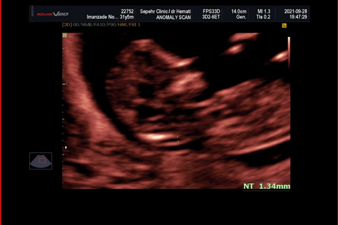 ریسک یا عدم ریسک در آزمایش ان تی ریسک یا عدم ریسک در آزمایش ان تی