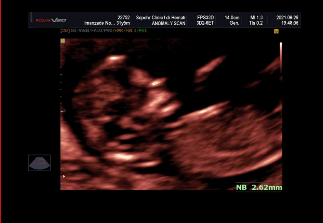 ریسک یا عدم ریسک در آزمایش ان تی ریسک یا عدم ریسک در آزمایش ان تی