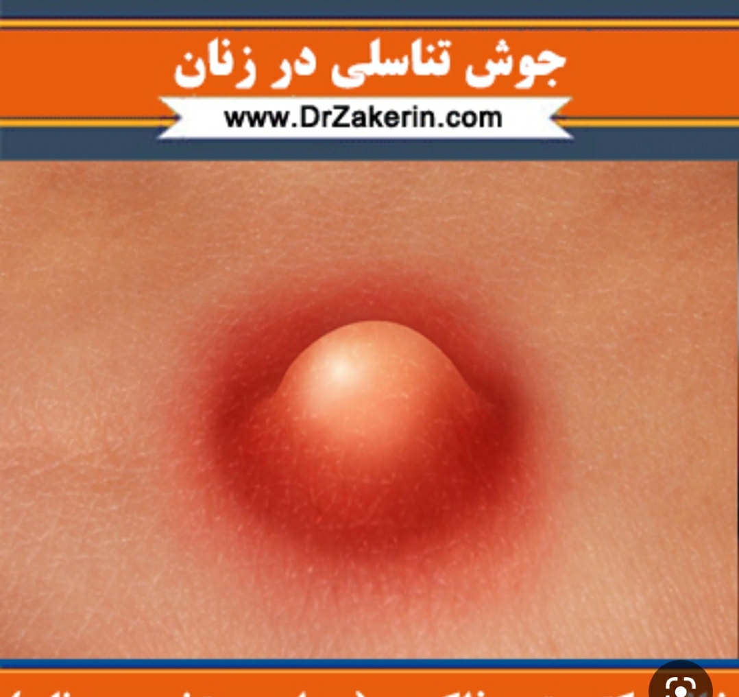خانم دکتر تقریبا اینجوریه ولی باین قرمزی وبرامدگی نیس کمتره خانم دکتر تقریبا اینجوریه ولی باین قرمزی وبرامدگی نیس کمتره