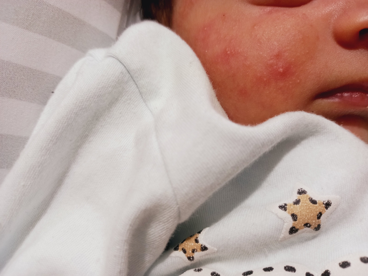 جوش صورت نوزاد یک ماهه جوش صورت نوزاد یک ماهه