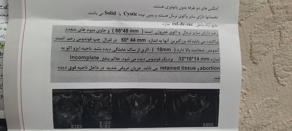 سونوگرافی بعداز سقط همراه با عکس سونو