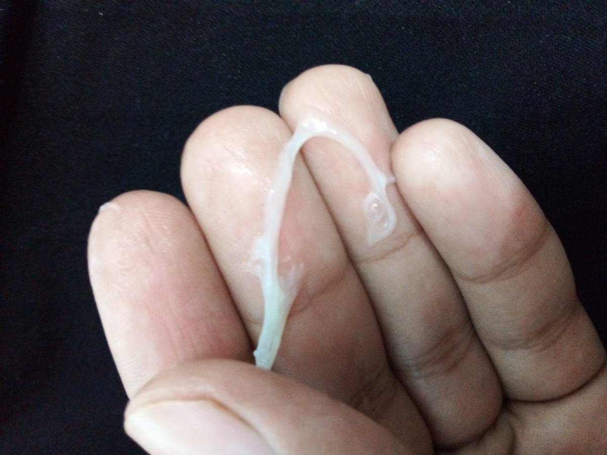 علت ترشحات خلطی و چسبناک+عکس علت ترشحات خلطی و چسبناک+عکس