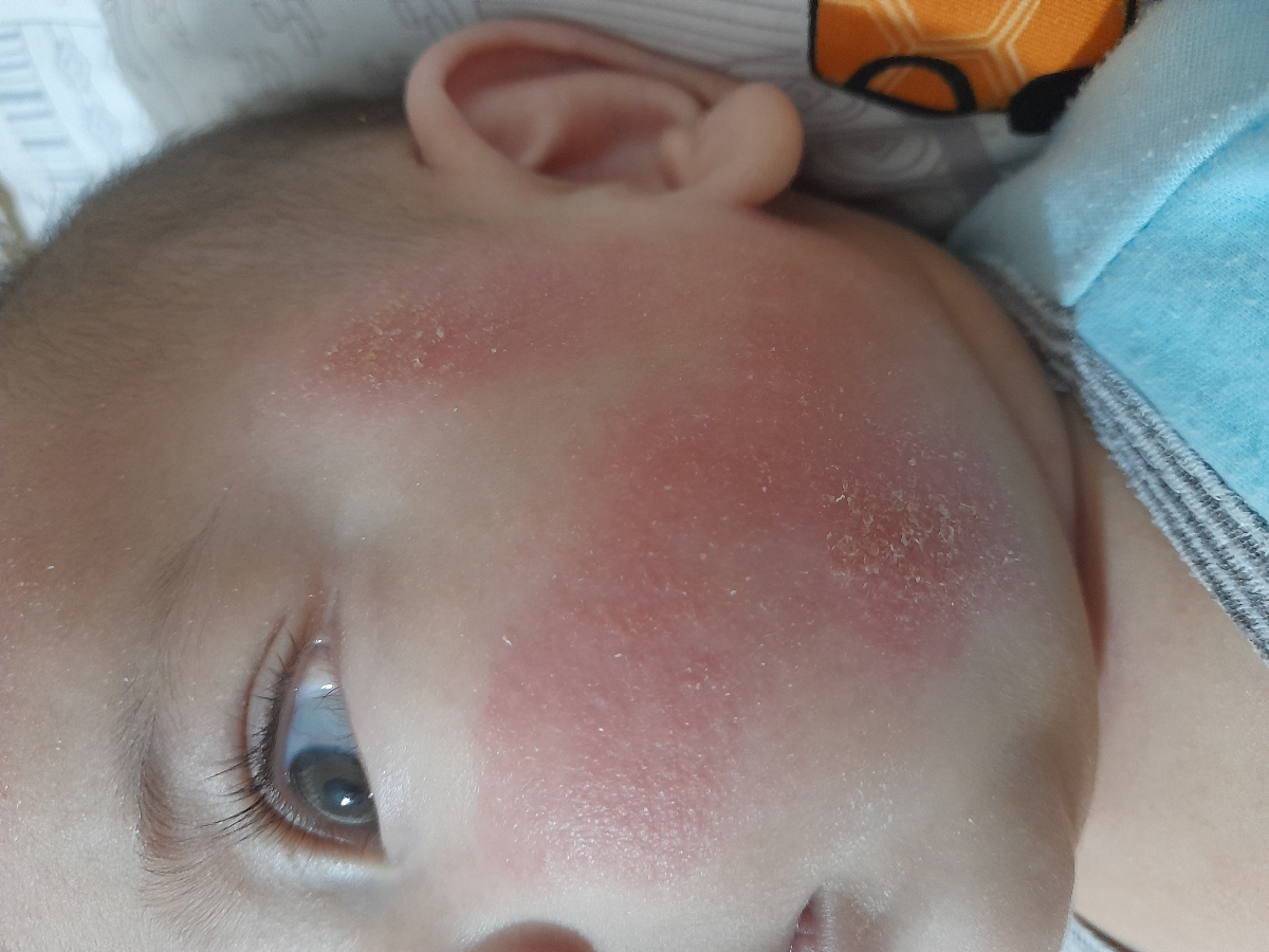 دوستانی که صورت نوزادشون خشک،قرمز و پوست پوست میشه بیاین دوستانی که صورت نوزادشون خشک،قرمز و پوست پوست میشه بیاین