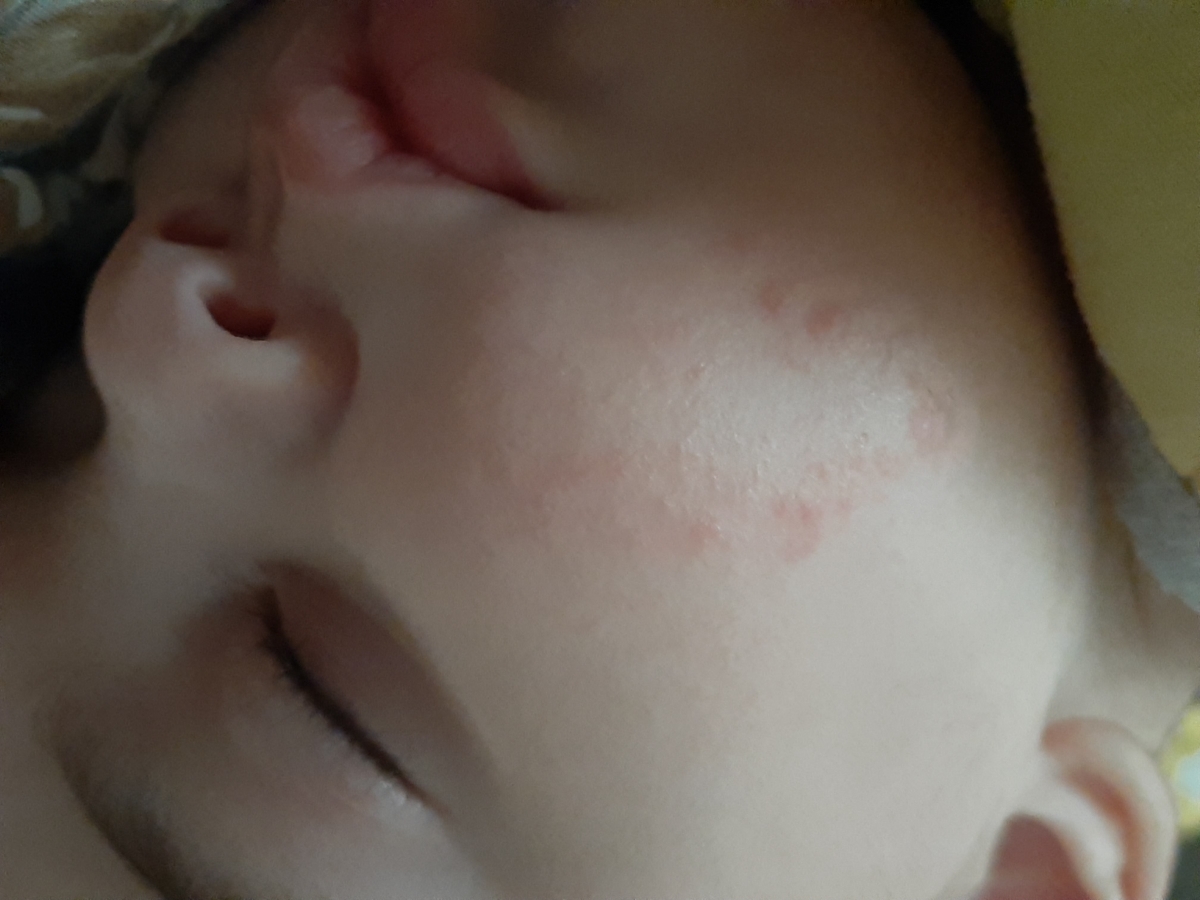 حساسیت روی گونه نوزاد