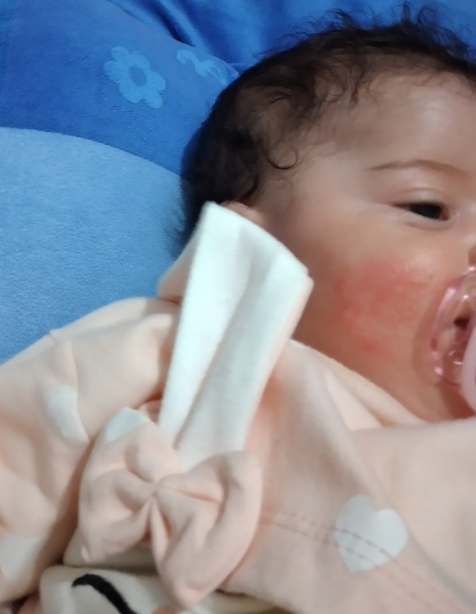 حساسیت و خارش صورت نوزاد حساسیت و خارش صورت نوزاد