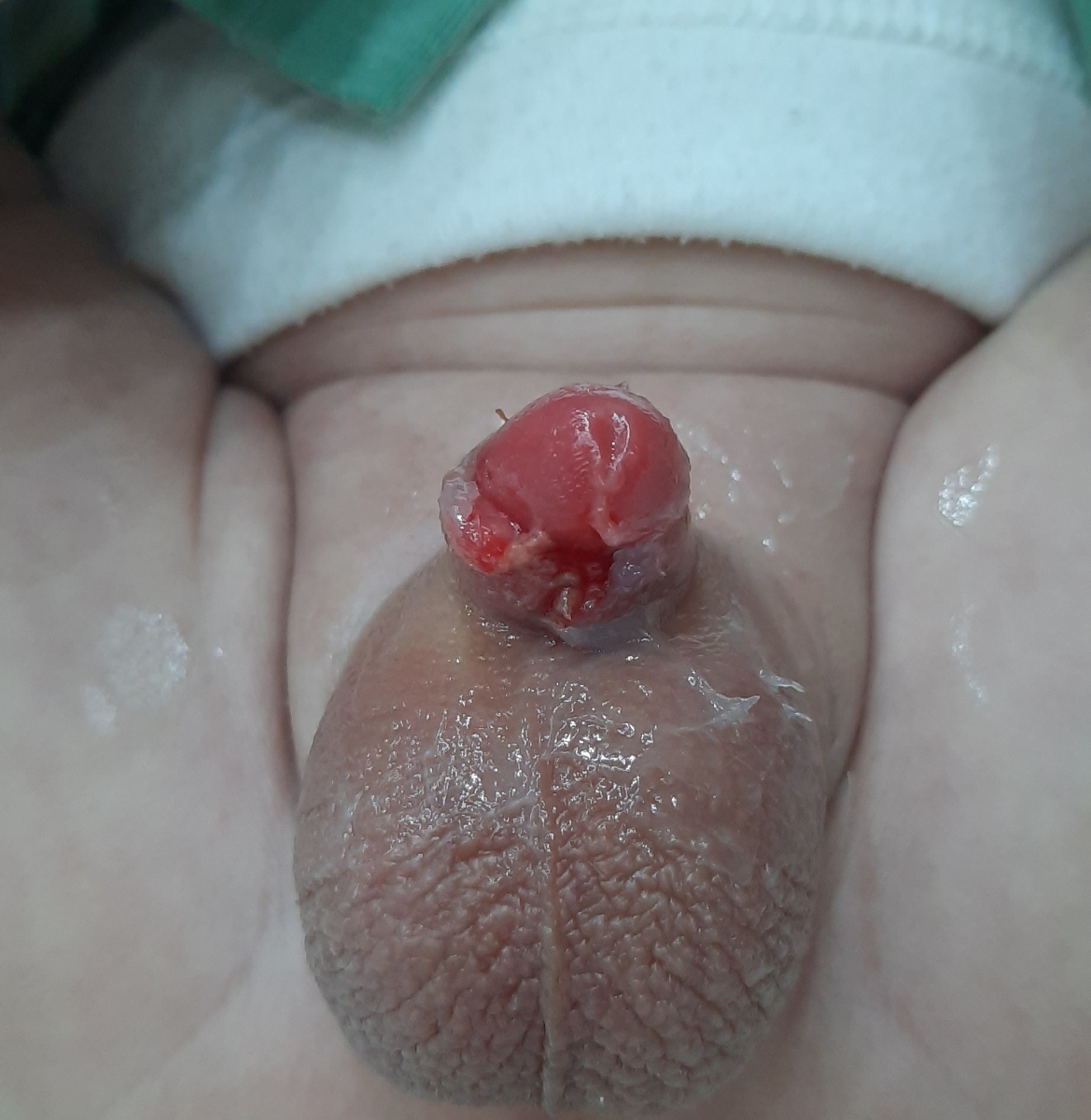 شکل ختنه نوزاد ۱ ماهه شکل ختنه نوزاد ۱ ماهه