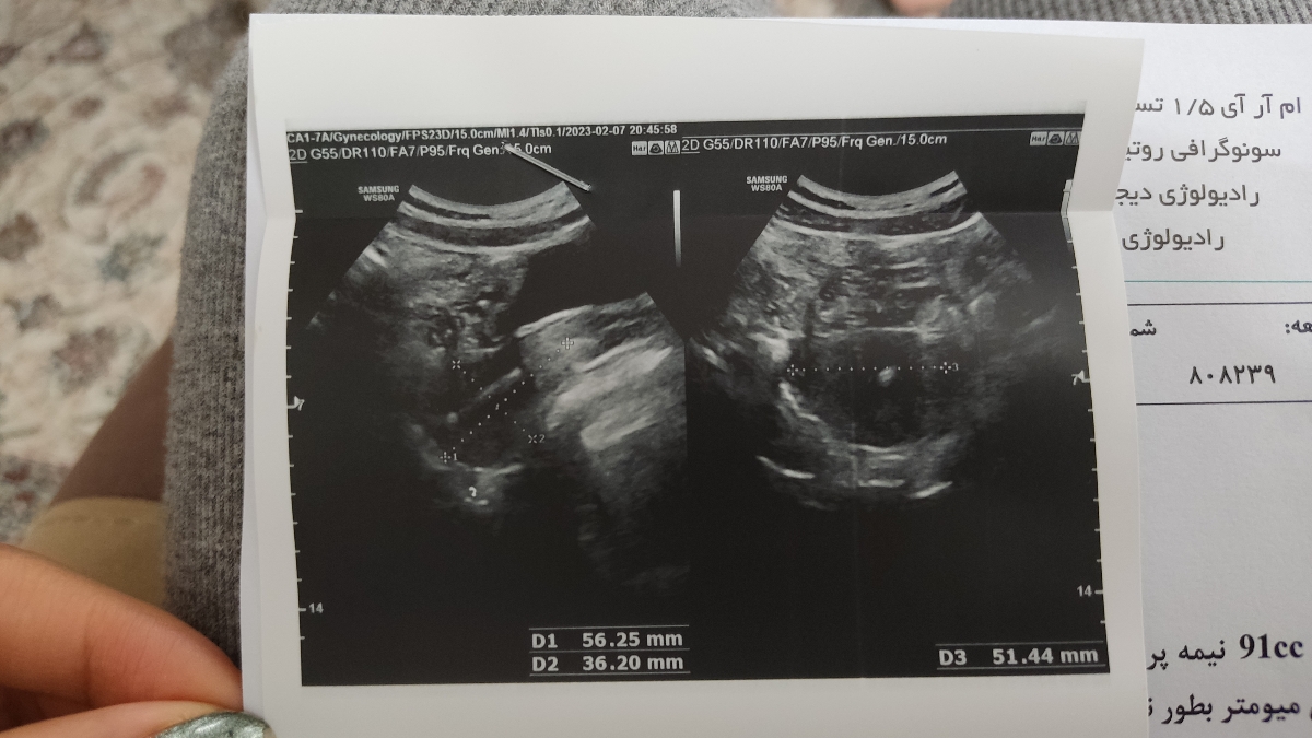 تفسیر سونوگرافی رحم و تخمدان تفسیر سونوگرافی رحم و تخمدان