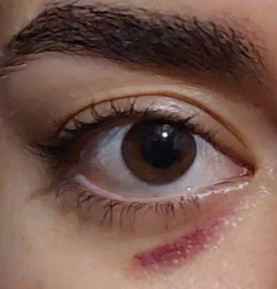 چکار کنم کبودی زیرچشمم زودتر خوب بشه(عکس) چکار کنم کبودی زیرچشمم زودتر خوب بشه(عکس)