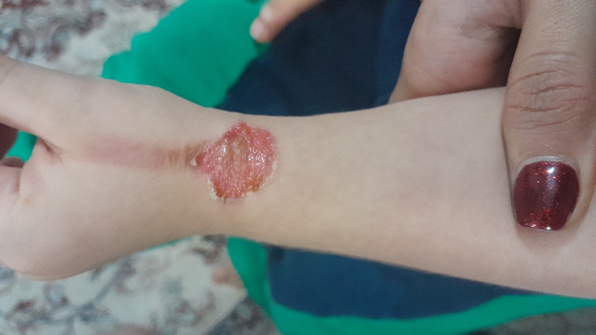 سوختگی دست پسرم با آب جوش سوختگی دست پسرم با آب جوش