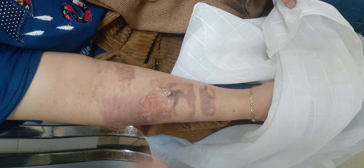 سوختگی دست پسرم با آب جوش سوختگی دست پسرم با آب جوش