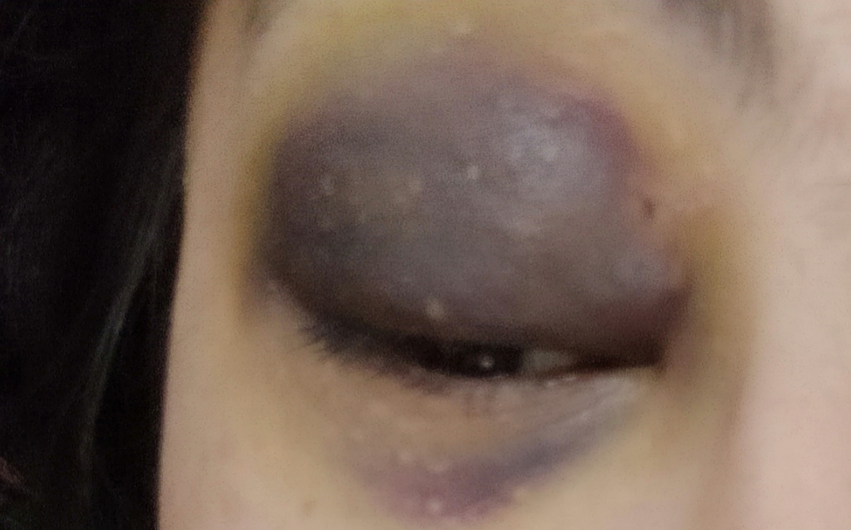 چکار کنم کبودی زیرچشمم زودتر خوب بشه(عکس) چکار کنم کبودی زیرچشمم زودتر خوب بشه(عکس)