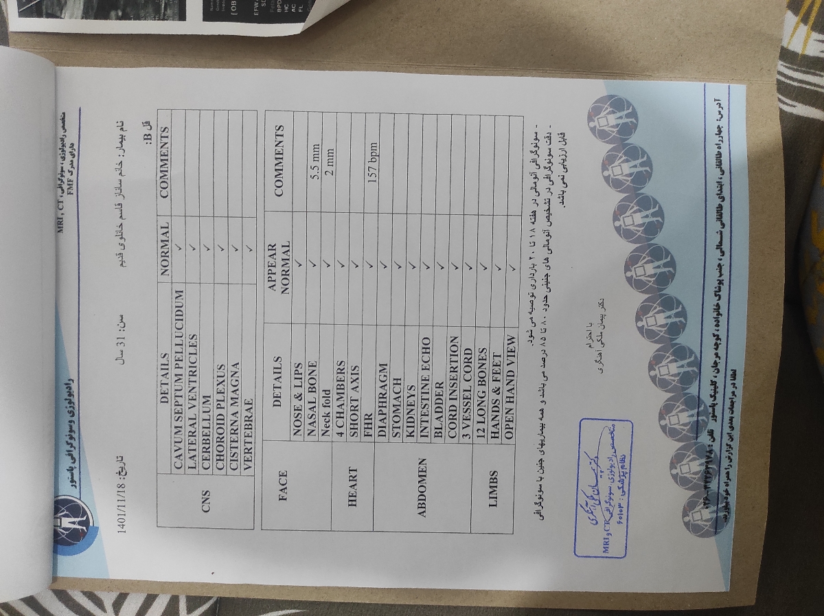 سونوی انومالی بارداری دوقلویی