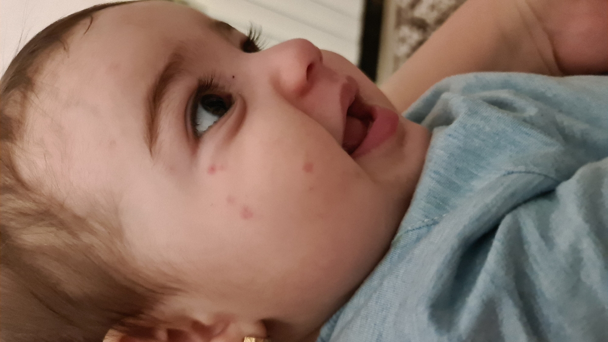جوش روی یک طرف صورت کودک ۱ ساله + عکس جوش روی یک طرف صورت کودک ۱ ساله + عکس