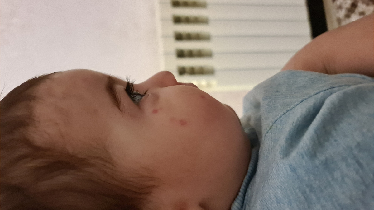 جوش روی یک طرف صورت کودک ۱ ساله + عکس جوش روی یک طرف صورت کودک ۱ ساله + عکس