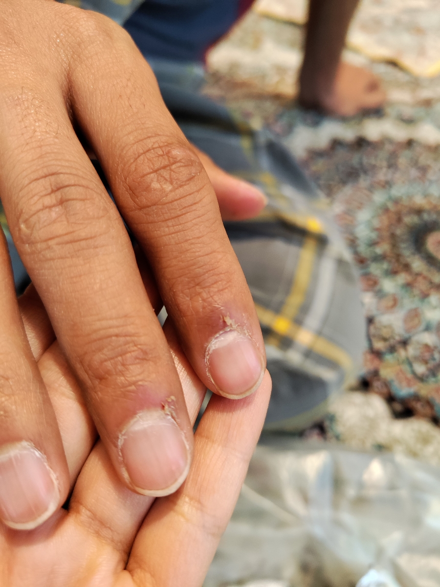 پوسته شدن کنار ناخن ها پوسته شدن کنار ناخن ها