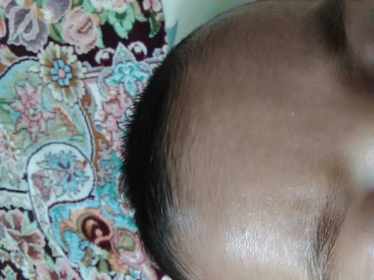 این سفیدک روی پیشونی پسرم چیه؟ این سفیدک روی پیشونی پسرم چیه؟