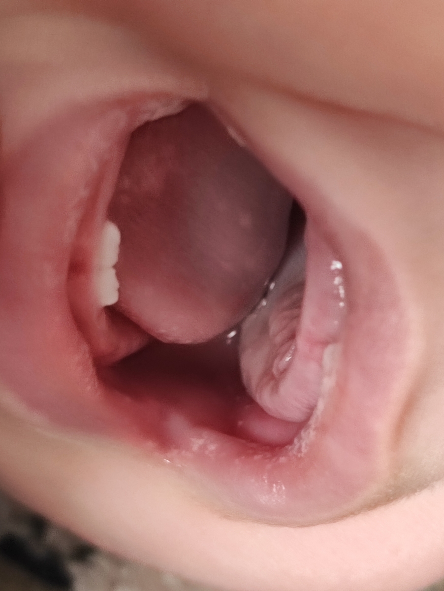 چک برفک دهان شیرخوار چک برفک دهان شیرخوار