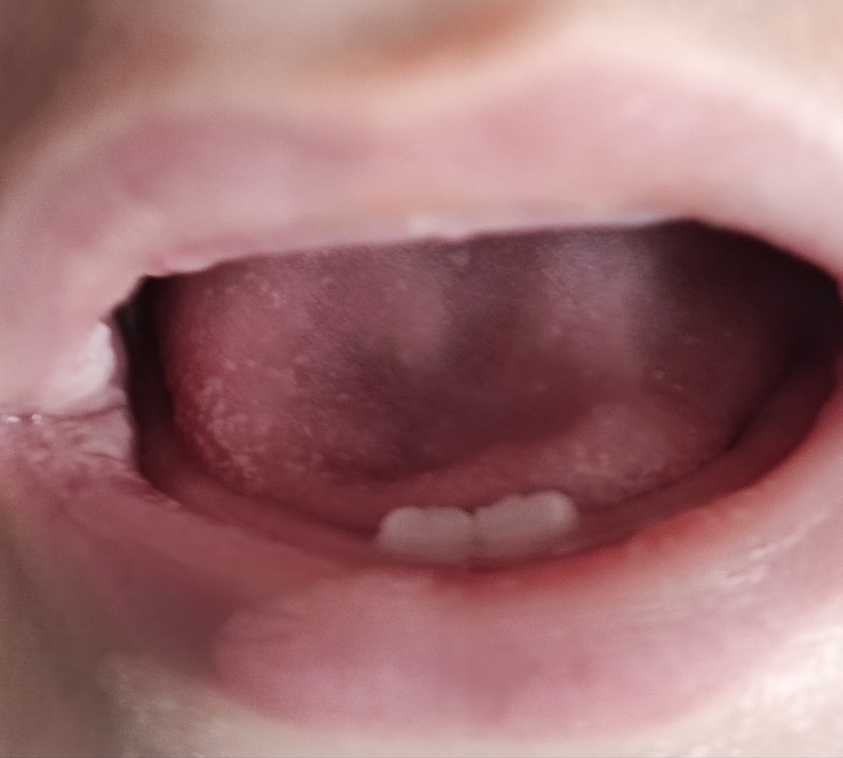 چک برفک دهان شیرخوار چک برفک دهان شیرخوار