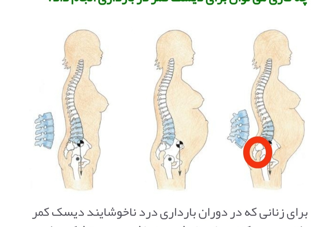 درد مقعد و استخوان پشت مقعد درد مقعد و استخوان پشت مقعد