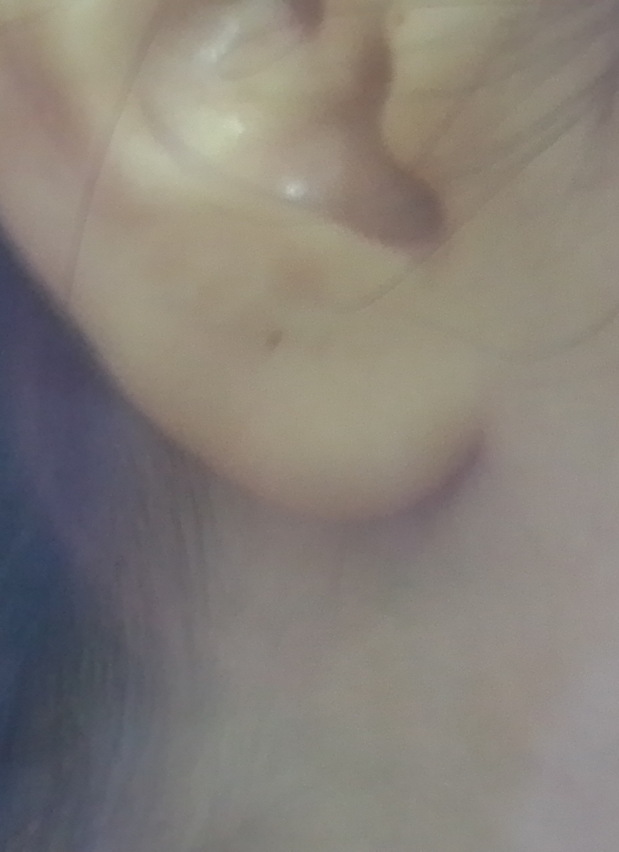 عفونت گوش قسمت سوراخ گوش