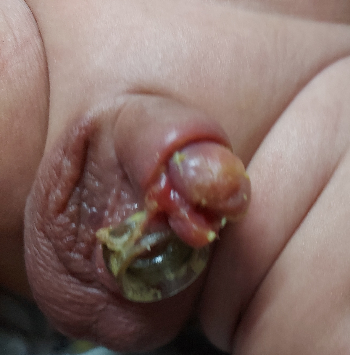ختنه نوزاد پسر ۱ماهه ختنه نوزاد پسر ۱ماهه