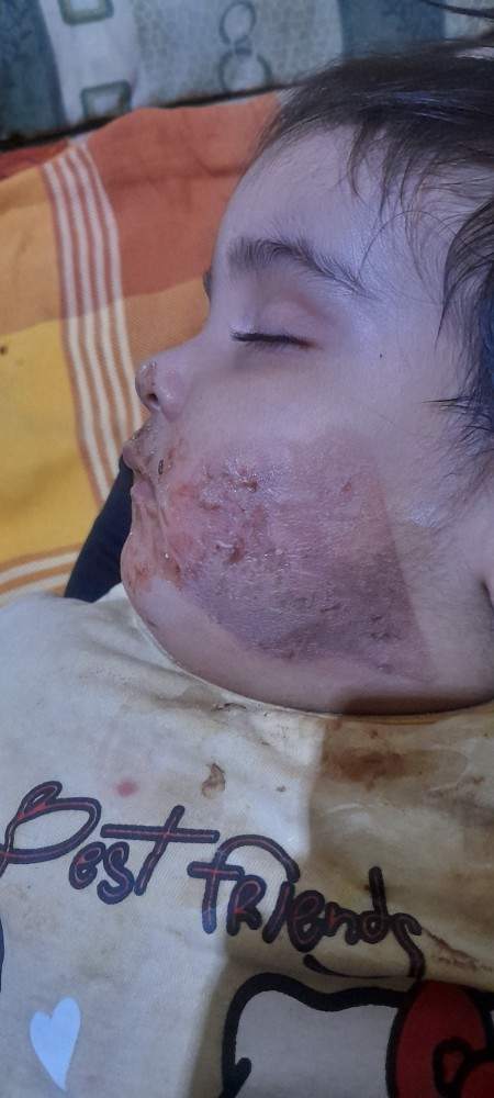 سلام خانوما دختر خواهرم صورتش سوخته یسالشه چکار ... سلام خانوما دختر خواهرم صورتش سوخته یسالشه چکار ...