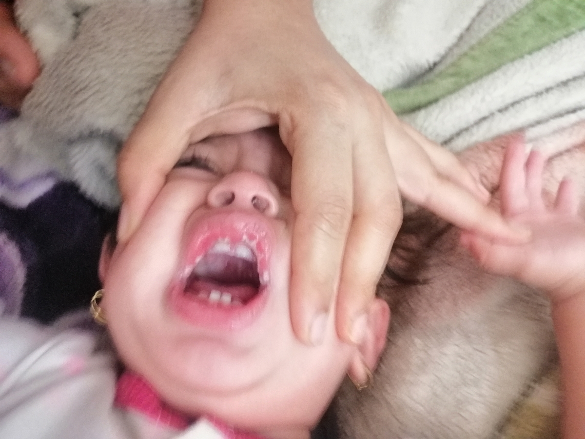 پوسته شدن لب علت پوسته شدن لب علت