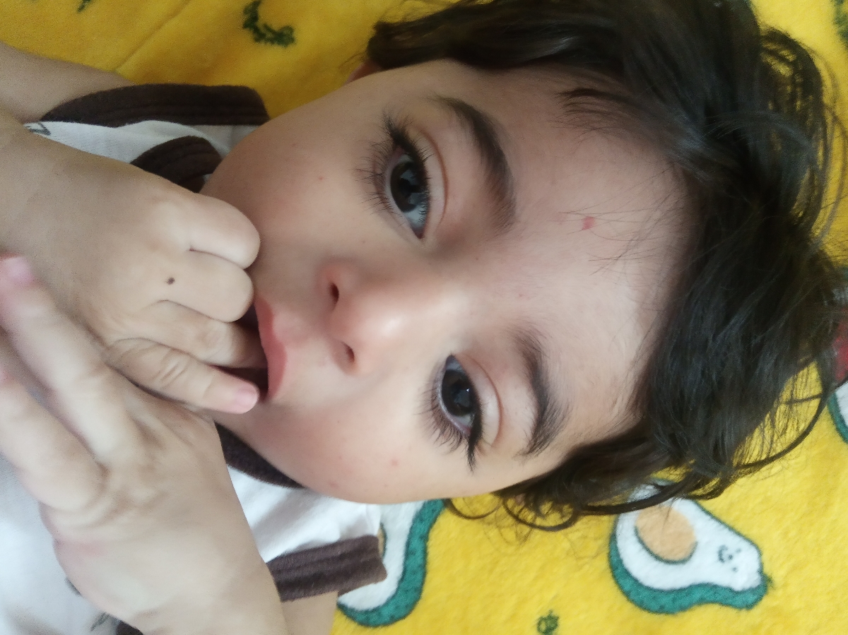 حالت خون مردگی یا جمع شدن لکه های قرمز خونی روی صورت کودک حالت خون مردگی یا جمع شدن لکه های قرمز خونی روی صورت کودک