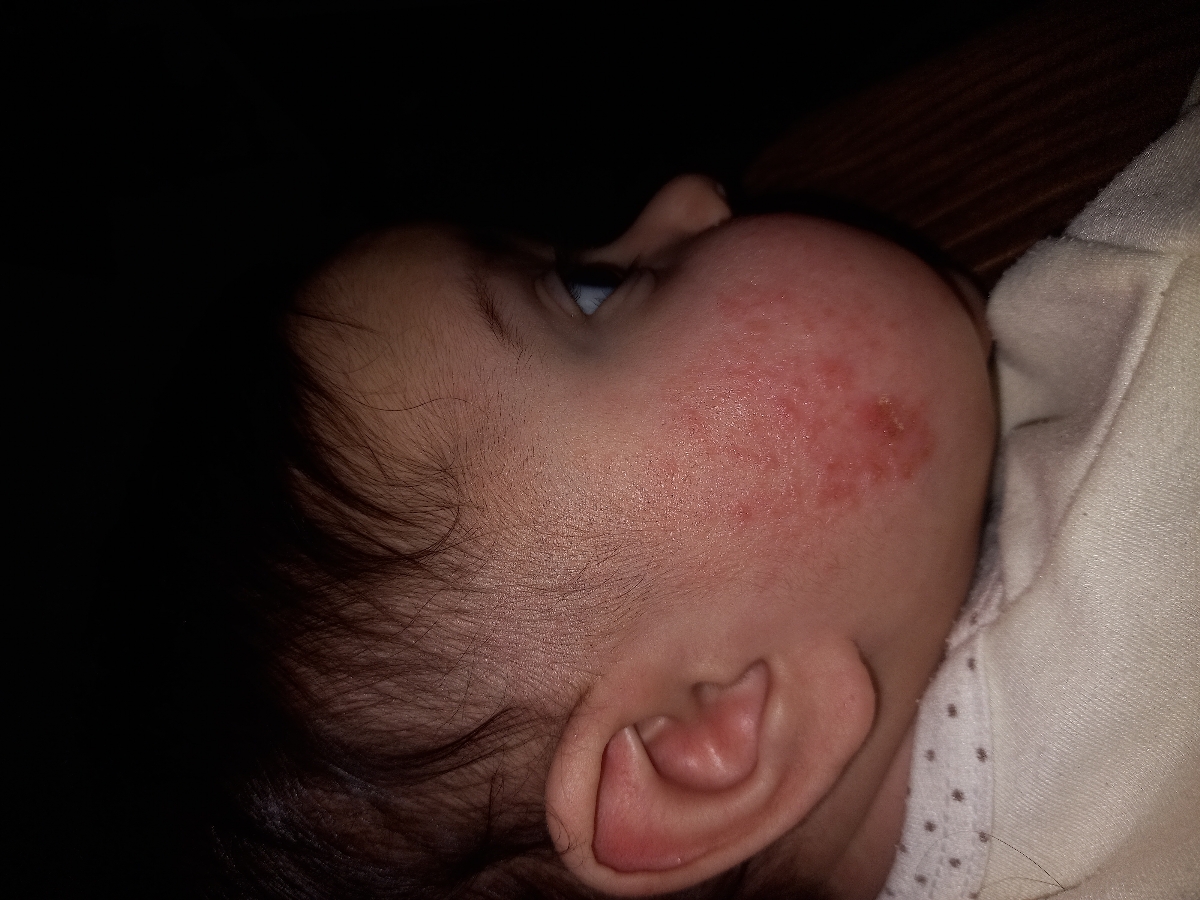 قرمزی روی صورت نوزاد قرمزی روی صورت نوزاد