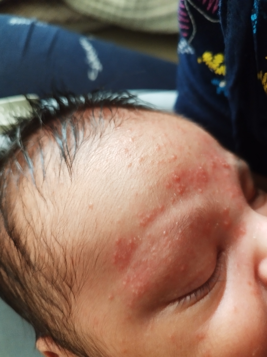 جوش زیاد صورت نوزاد