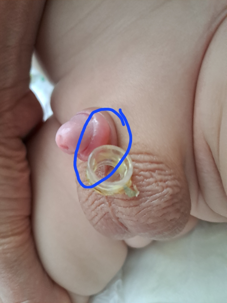 تورم و قرمزی ختنه پسرم همراه با عکس تورم و قرمزی ختنه پسرم همراه با عکس