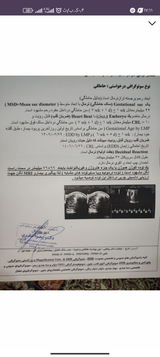 کیست درموئید در بارداری