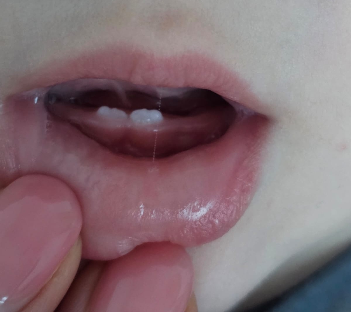 خارش صورت نوزاد ۵ ماهه خارش صورت نوزاد ۵ ماهه