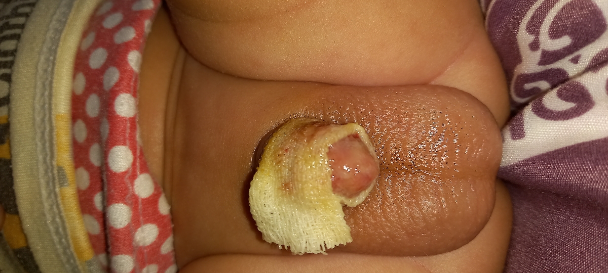 ختنه به همراه عکس ختنه به همراه عکس