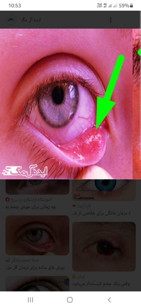 درمان گل مژه درون پلک درمان گل مژه درون پلک