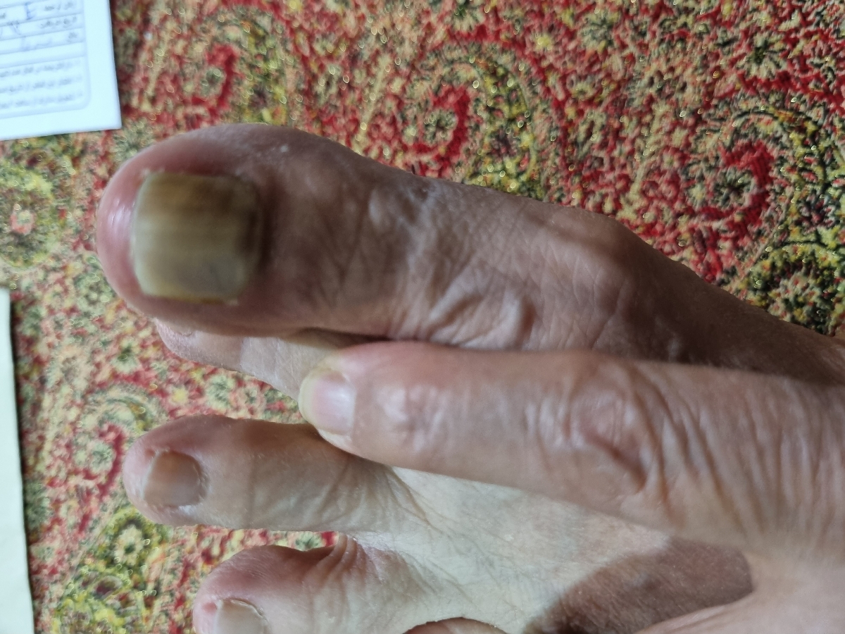کبود شدن و عفونت ناخن پا کبود شدن و عفونت ناخن پا