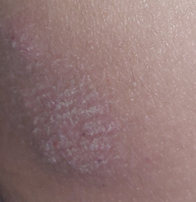 سلام خانم دکتر خسته نباشین رو گودی باسنم پوستم این شکلی شده