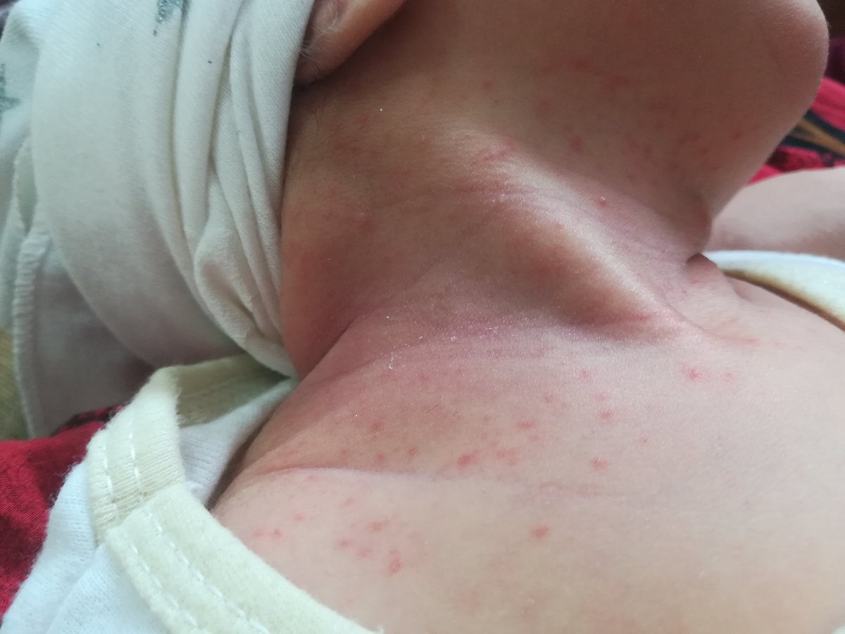 دونه های قرمز رو گردن و سینه بچه ام در اومده علتش چیه ممکنه گرمی باشه یا نه؟؟؟