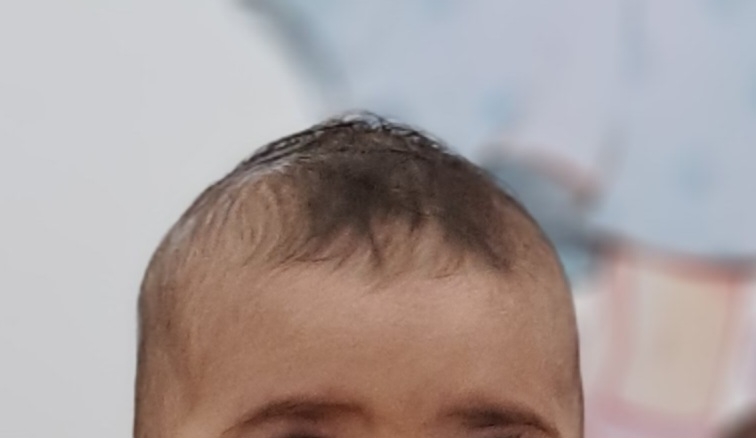 کم مو بودن موی سر نوزاد ۸ ماهه