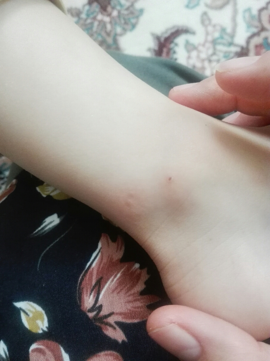 دونه های قرمز روی صورت و پای کودک دونه های قرمز روی صورت و پای کودک