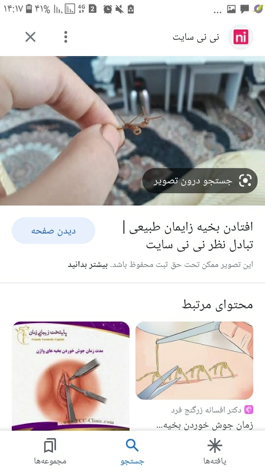 افتادن بخیه های جذبی داخلی بعد ۵۴ روز(سزاینی هستم) افتادن بخیه های جذبی داخلی بعد ۵۴ روز(سزاینی هستم)