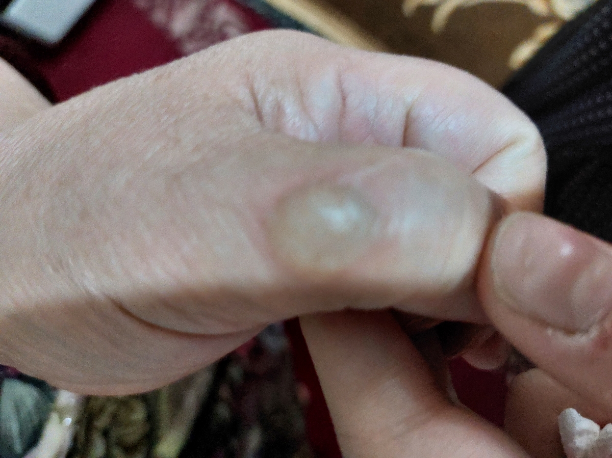 سوختگی وتاول دست مادرم سوختگی وتاول دست مادرم
