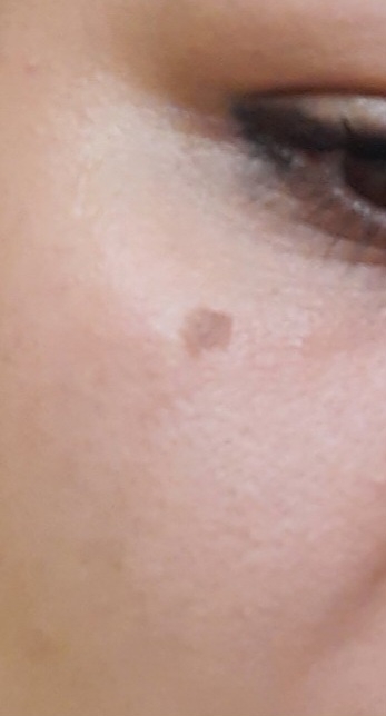 سلام صورت یه خال داره حس میکنم بزرگتر شده سلام صورت یه خال داره حس میکنم بزرگتر شده