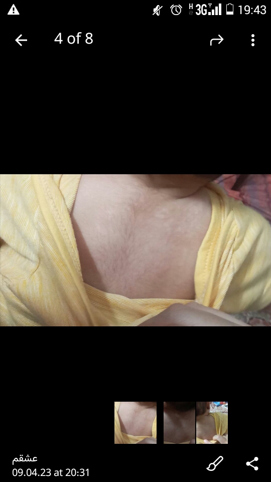 لکه پشت گردن نوزاد