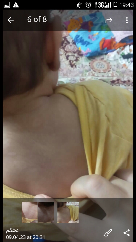 لکه پشت گردن نوزاد