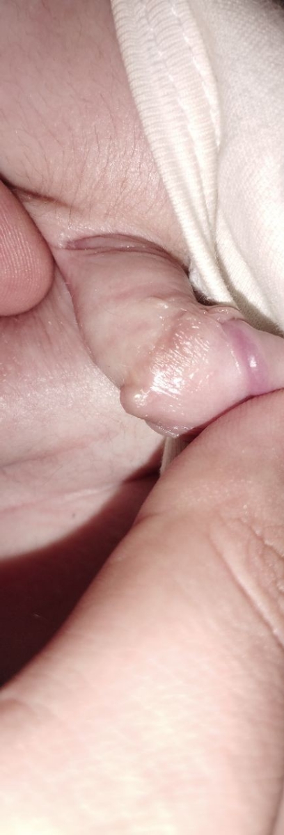 جای ختنه بخیه نوزاد