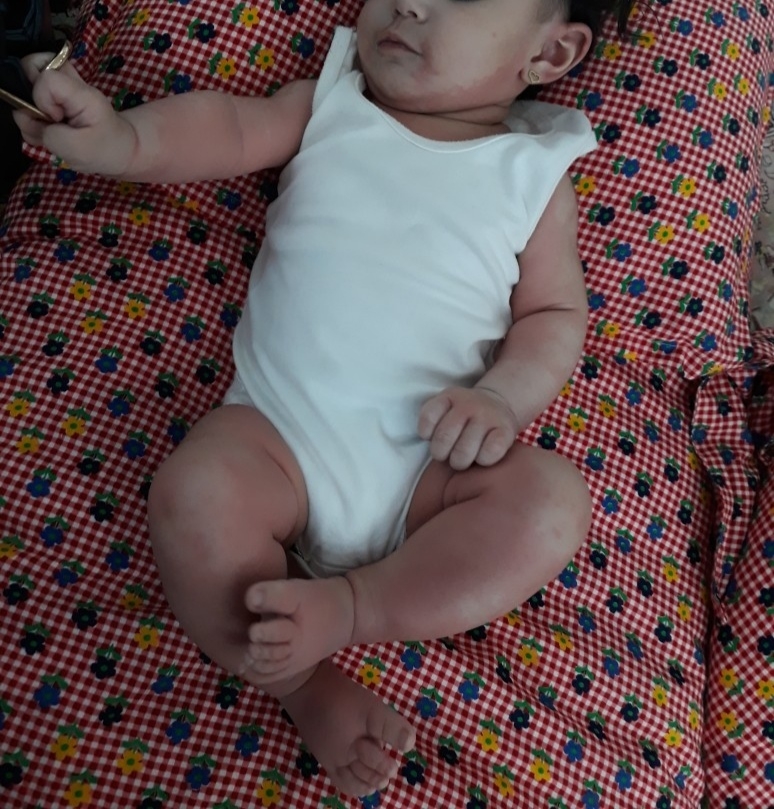 حساسیت به واکسن چهارماهگی