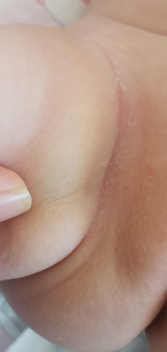 قرمزی و پوسته شدن کنار پای نوزاد