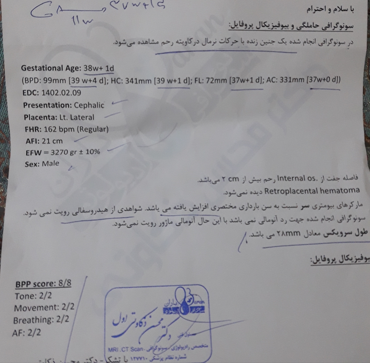 بزرگی خفیف سر جنین بزرگی خفیف سر جنین